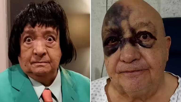 El comediante Luis de Alba fue hospitalizado, ¿qué le dejó el rostro morado?